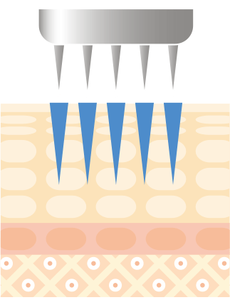 ダーマペン施術